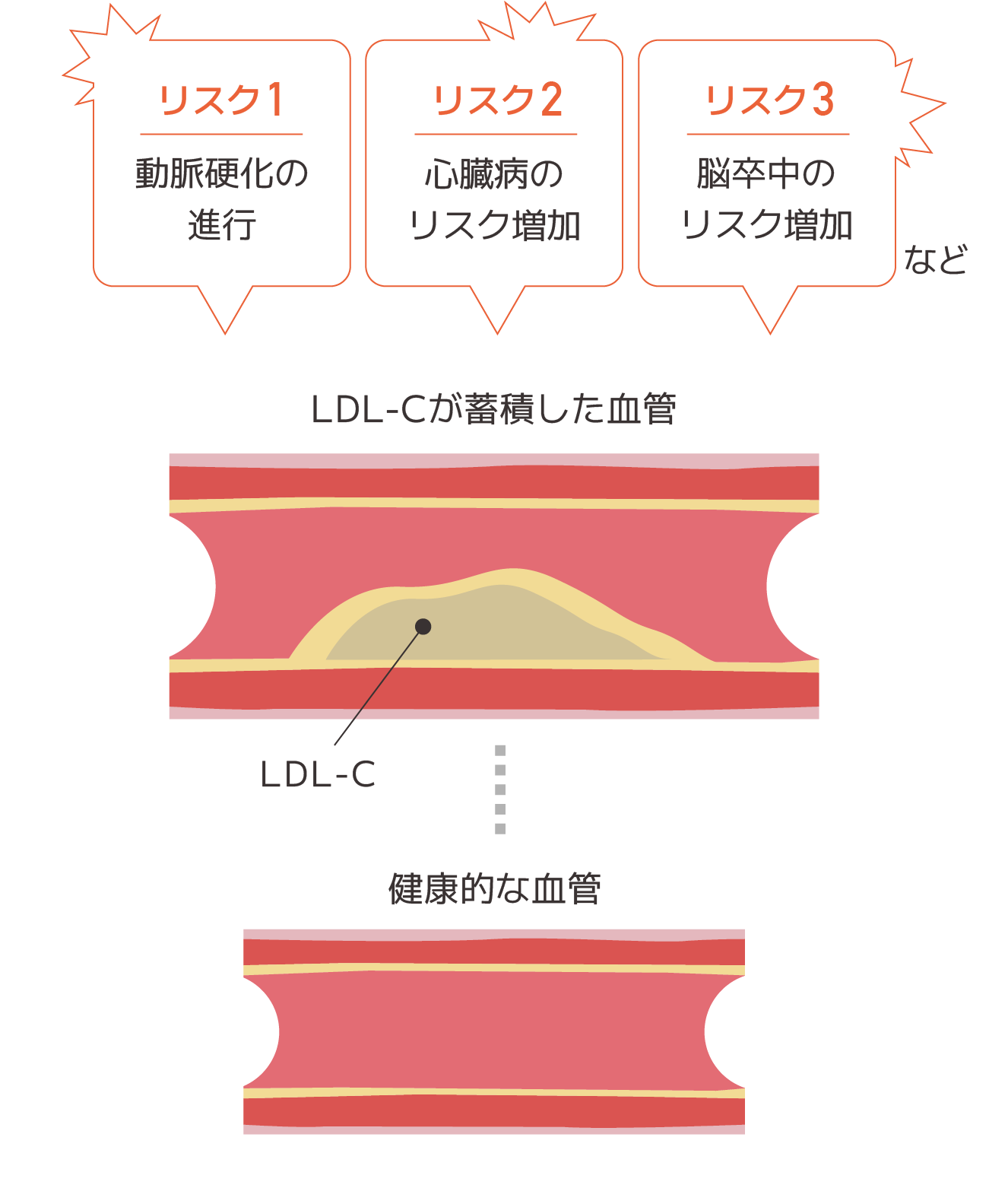 高コレステロールのリスク図 SP用