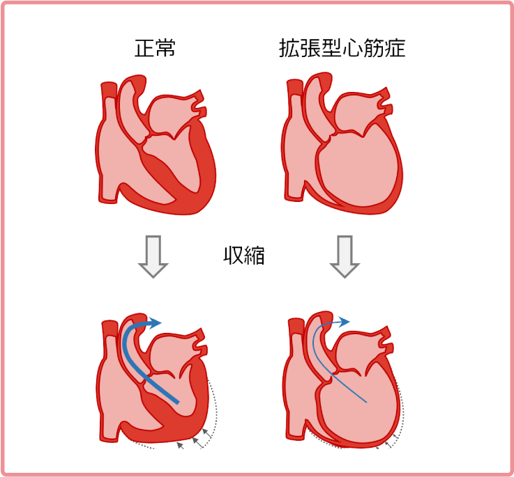 拡張型心筋症についてイラスト